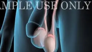 Medical Animation: Testicular Cancer