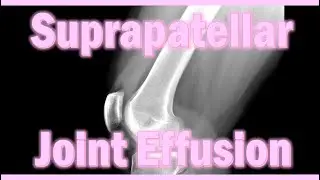 Suprapatellar Joint Effusion of the Knee  #Radiology #KneeImaging #SuprapatellarEffusion