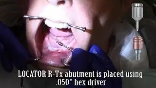 Zest's LOCATOR R-Tx Technique - Uncovering, Abutment Placement, and Impression Taking