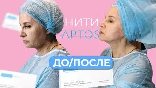 Нити APTOS ДО и ПОСЛЕ | Ставим нити APTOS | Мгновенная подтяжка лица