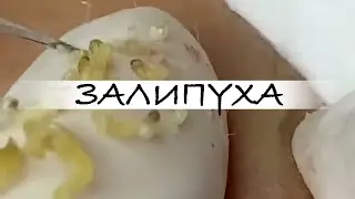 ПРЫЩИ 😍 ПРЫЩИ ВЫДАВЛИВАНИЕ 😍 ПОДБОРКА ВЫДАВЛИВАНИЕ ПРЫЩЕЙ 