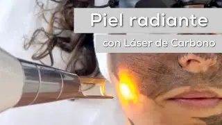 Láser de carbono: El Secreto para una Piel Radiante y Joven