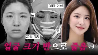 얼굴 크기 반갈 가능? ㅇㅇ 쌉가능🙆🏻 | 눈재+코재+윤곽3종+이마거상+실리프팅