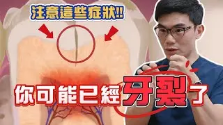 注意這些症狀！你可能已經牙裂了！｜Dr.Wells