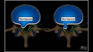 Рецидив грыжи после операции. Лечение.