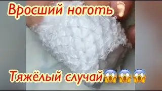 Вросший ноготь🦶🏻• Тяжёлый случай😱😱😱