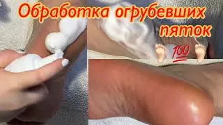 Обработка огрубевших пяток 🦶🏻💯😱