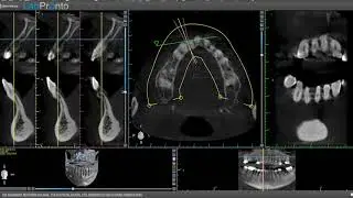 #dentalimplant CBCT implant planning and Pano planning