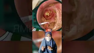 ASMR part 62 Keluar cairan dari Telinga 😱 |Mv 