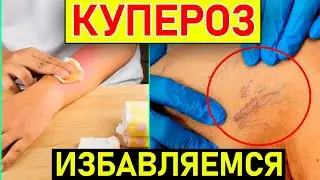 Сосудистые «ЗВЕЗДОЧКИ»❌ КАК ИХ УБРАТЬ?✅ 4 простых способа ИЗБАВИТЬСЯ от КУПЕРОЗА!