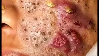 pimple popping |  blackheads removal | acne treatment