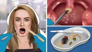 ASMR Remove The Fly & Tonsil Stone From Adele's Throat