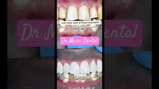 BEFORE & AFTER BRACES, Veneers , poor Job 👎🏻