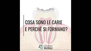 Cosa sono le Carie e perchè si formano?