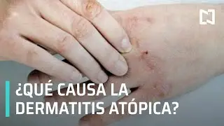 Dermatitis atópica - Expreso de la Mañana