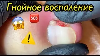Гнойное воспаление 😱⚠️🆘❗️🦶🏻