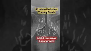 Prostate Radiation Therapy Seeds on X-Ray 