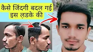 BEST HAIRLINE RESTORATION WORK ON A RECEDING HAIRLINE OF A YOUNG GUY ||