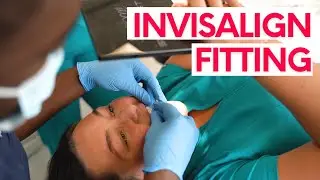 Invisalign Fit Appointment | Placing attachments on teeth