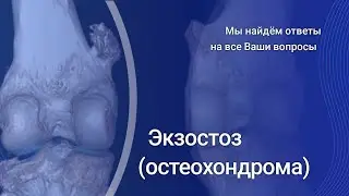 Экзостоз