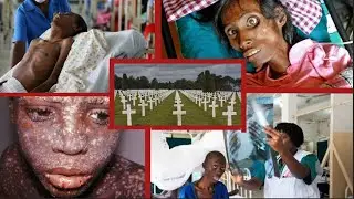 MAGONJWA HATARI YALIYOTIKISA DUNIA NA KUUA MAMILIONI YA WATU