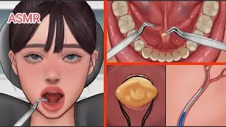ASMR | Salivary Gland Stones Removal Animation | ASMR DEV