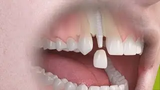 Straumann - Trattamento singolo dente su impianto in ceramica