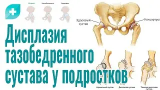 Дисплазия тазобедренного сустава у подростков