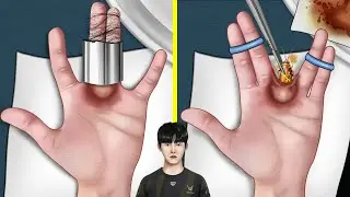 [ASMR Animation] Help Chovy Remove cockroach from finger gap