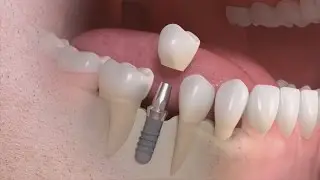 Straumann - Tratamento de um único dente com solução implanto-suportada