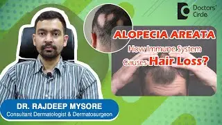 ALOPECIA AREATA & Triggers. How to prevent PATCHY HAIR LOSS? - Dr. Rajdeep Mysore | Doctors' Circle