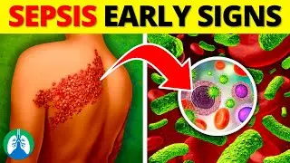 Top 10 Early Warning Signs of Sepsis | NEVER Ignore THIS