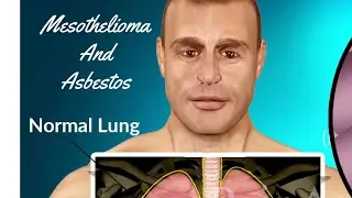 Mesothelioma And Asbestos