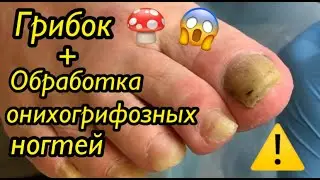 Грибок🍄 + Обработка онихогрифозных ногтей🦶🏻🆘⚠️