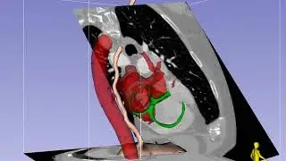 Deep Transgastric Long-Axis Imaging Plane in Transesophageal Echocardiography - Standard View