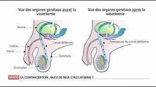 VASECTOMIE: COMMENT ÇÀ MARCHE ?