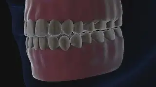 What's the deal with DIY tooth filing on TikTok?