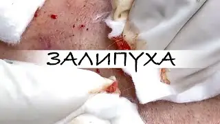 ВЫДАВЛИВАНИЕ ПРЫЩЕЙ 😍 ПРЫЩИ НА ЛИЦЕ 😍 #asmr #acne #прыщи