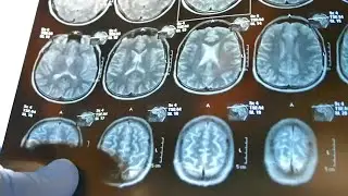 New brain tumor drug hits market 16 years after Duke neurosurgeon's discovery: ' Excited'