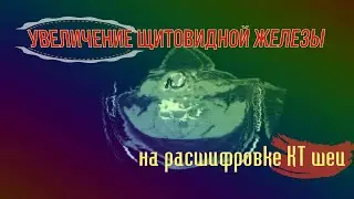 ДИФФУЗНЫЕ ИЗМЕНЕНИЯ щитовидной железы при ее УВЕЛИЧЕНИИ на РАСШИФРОВКЕ КТ мягких тканей шеи