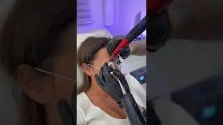 Удаление татуажа бровей лазером, под дальнейшее перекрытие будет пудровое напыление)