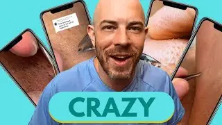 Dermatologist Reacts to Pimple Popping, Cyst Popping