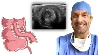 Intussusception - Making the Diagnosis