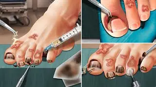 ASMR  Remove ingrown toenails, cut toenails and beautify toenails