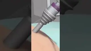Как проходит эндоскопическая операция? Смотри описание! Тут много полезного о медицине и здоровье
