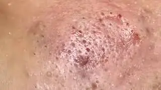 Remoção de cravo 2021 - Pimple Popping 2021 -Blackhead Removal  EP0018