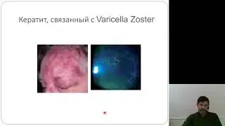 Офтальмология 2.Кератиты