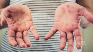 Measles outbreak | Staying safe during upcoming travel season