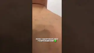 Удалили татуировку без шрамов в Sokolov Laser