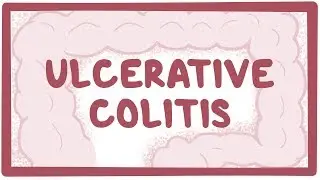 Ulcerative colitis - causes, symptoms, diagnosis, treatment, pathology
